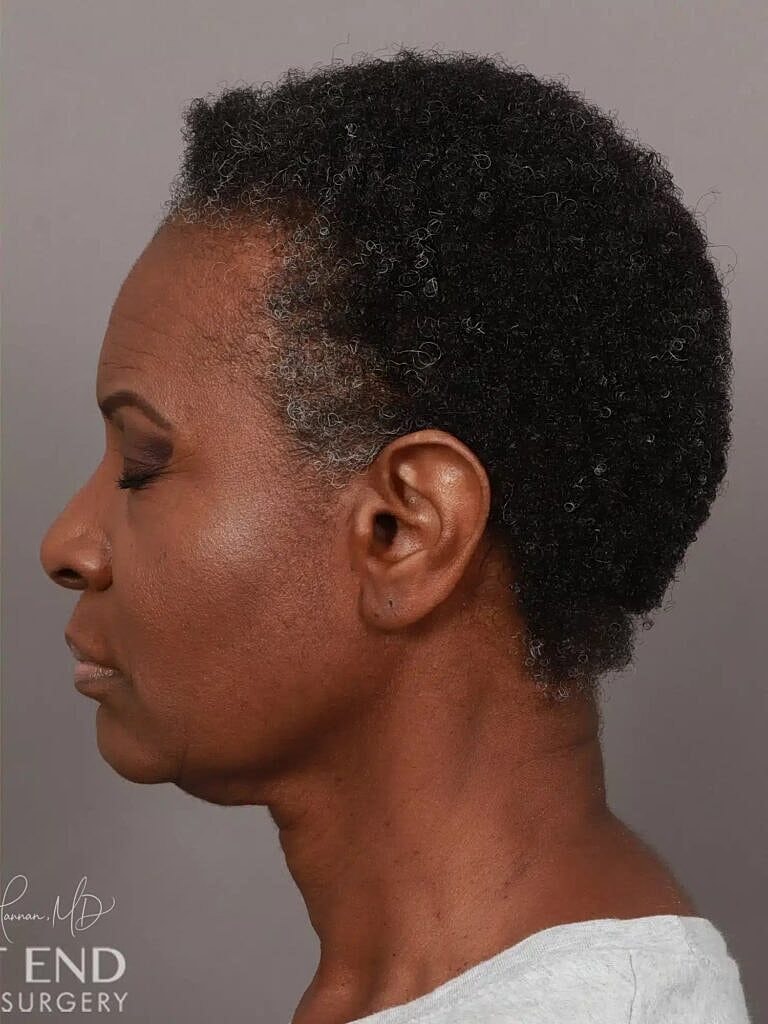 Hair Restoration Before & After