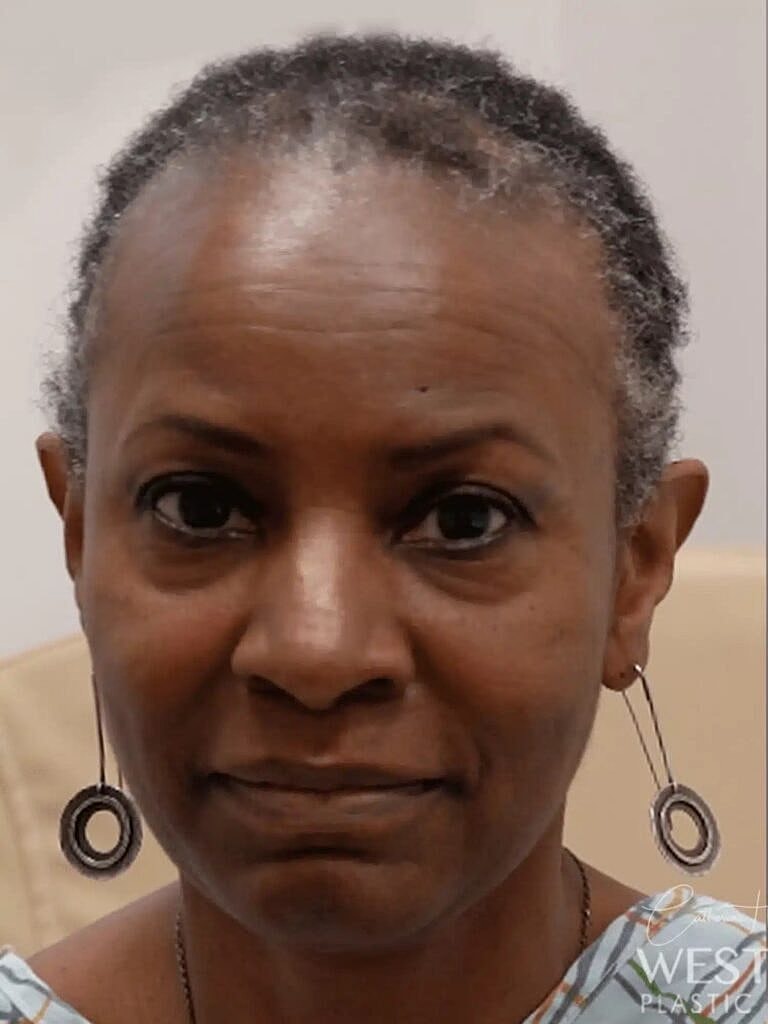 Hair Restoration Before & After