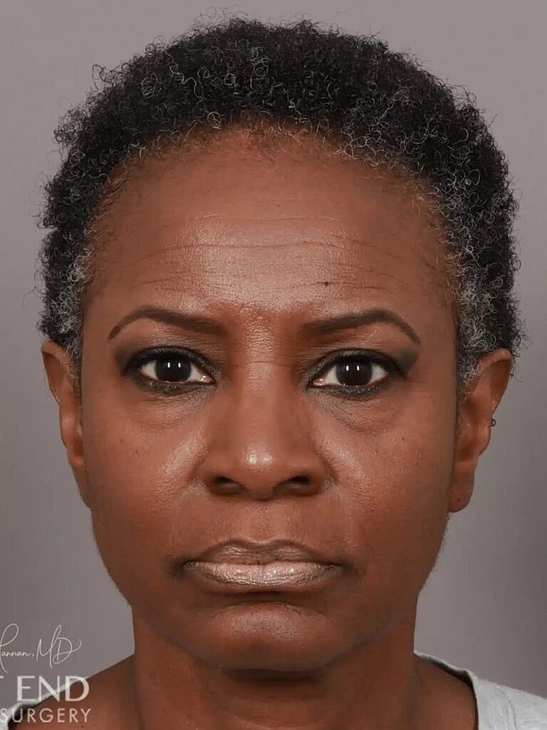 Hair Restoration Before & After