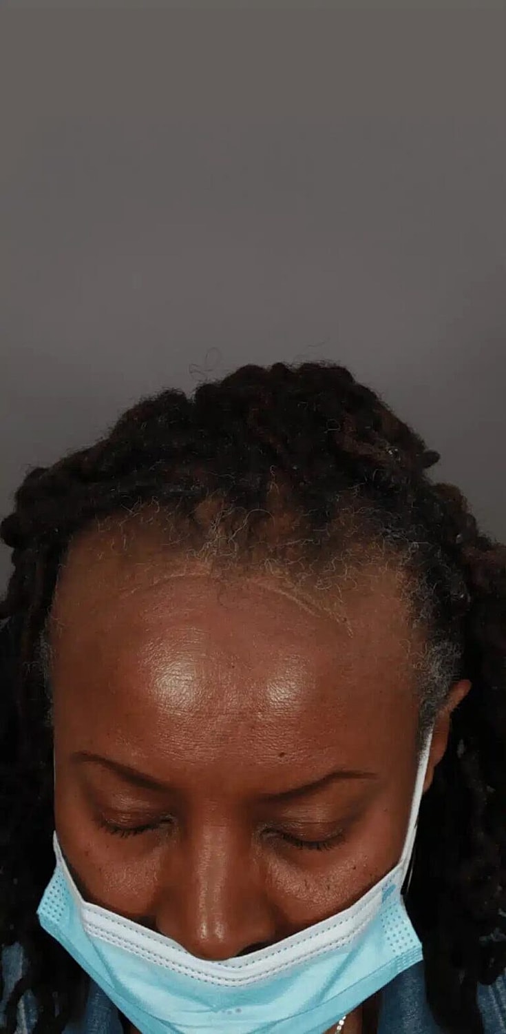 Hair Restoration Before & After