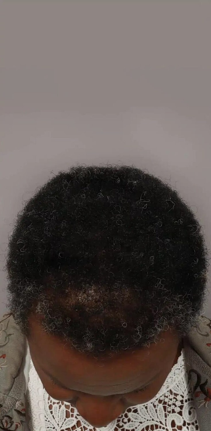 Hair Restoration Before & After