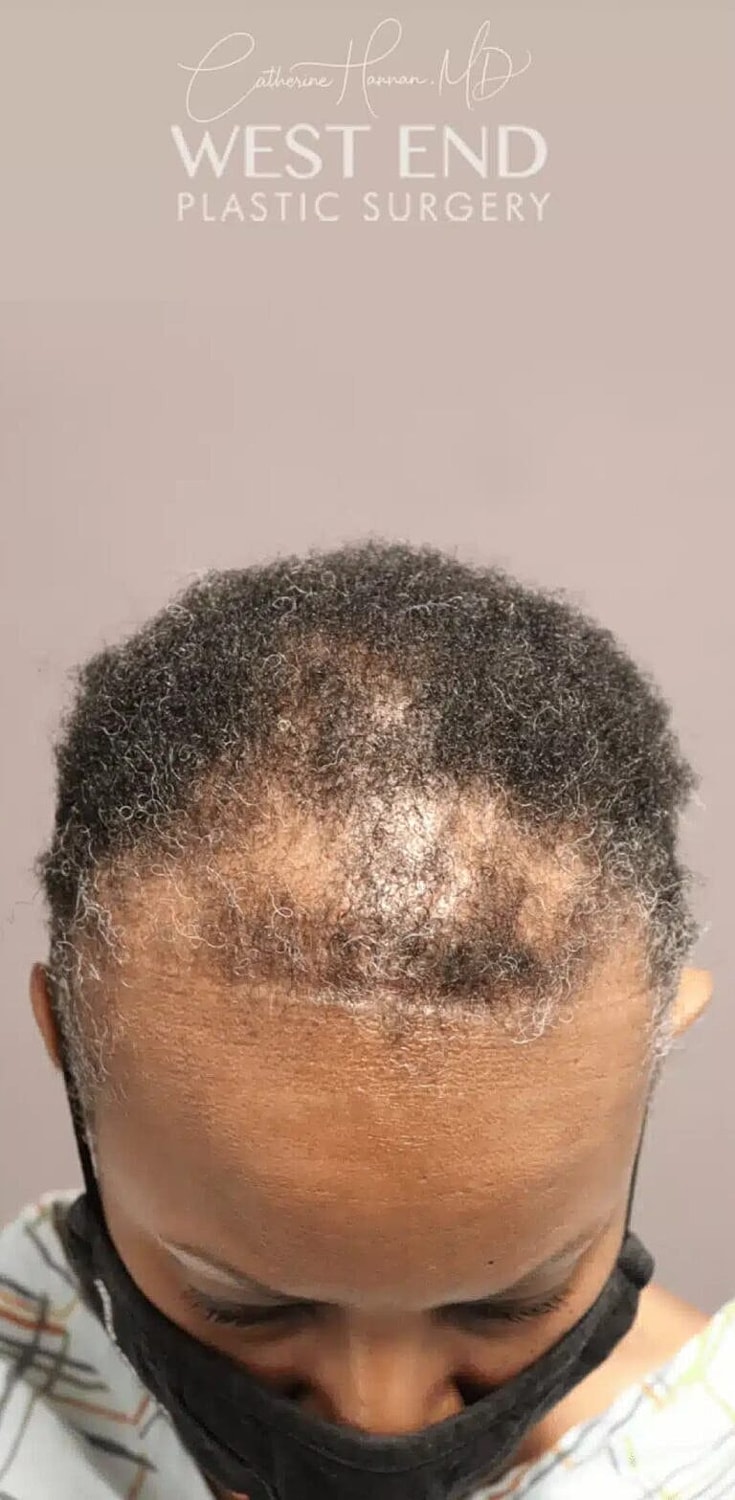 Hair Restoration Before & After