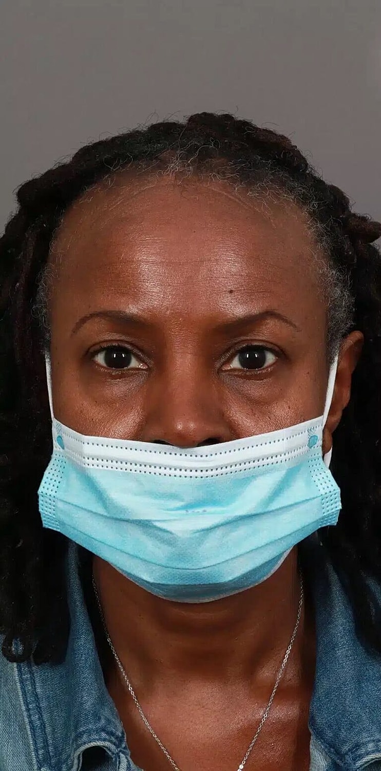 Hair Restoration Before & After