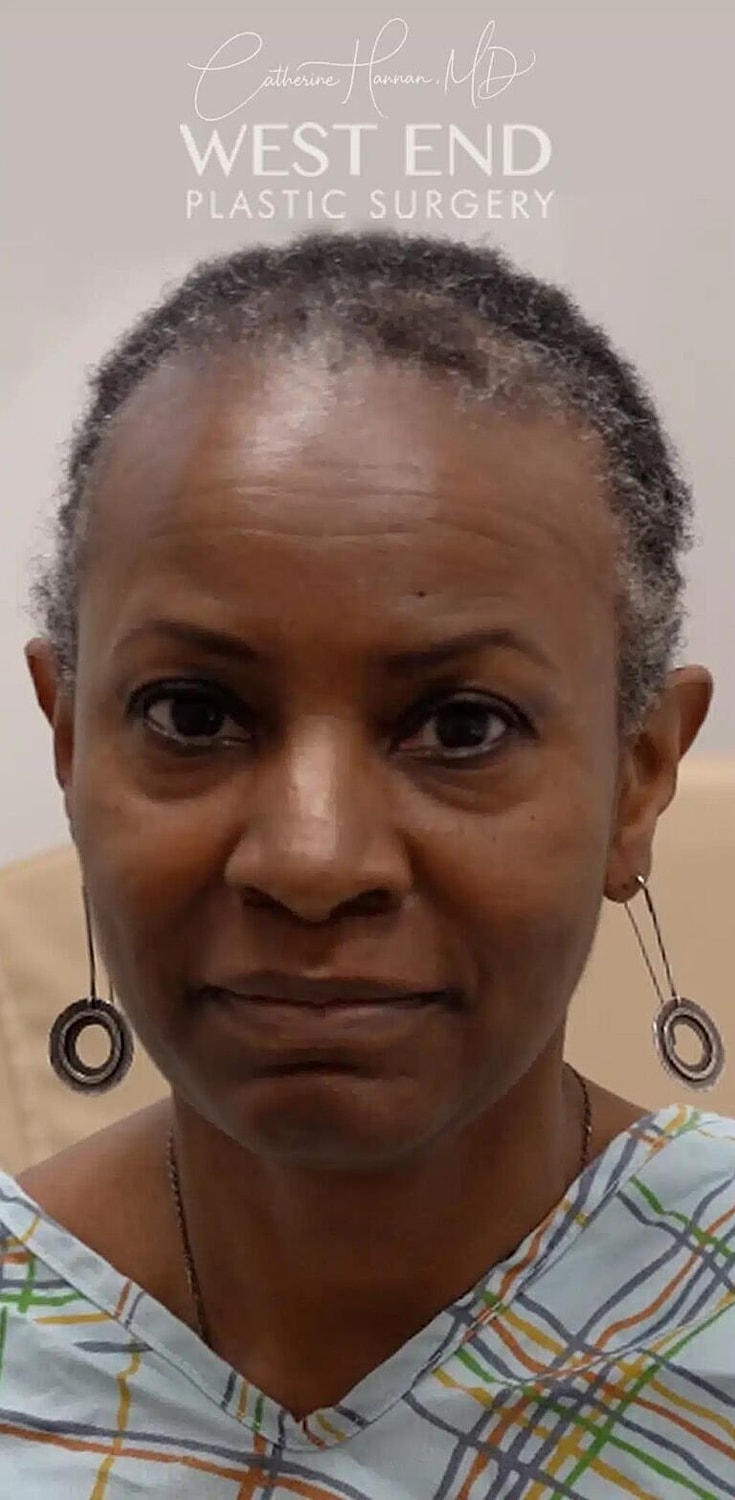 Hair Restoration Before & After