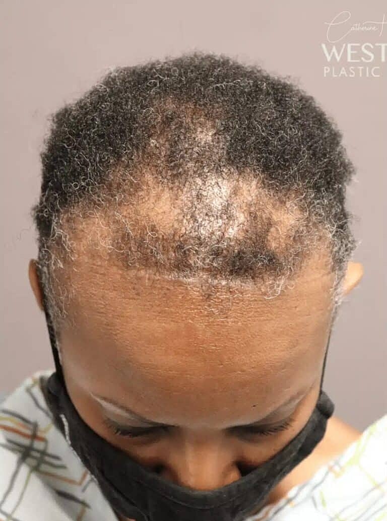 Hair Restoration Before & After