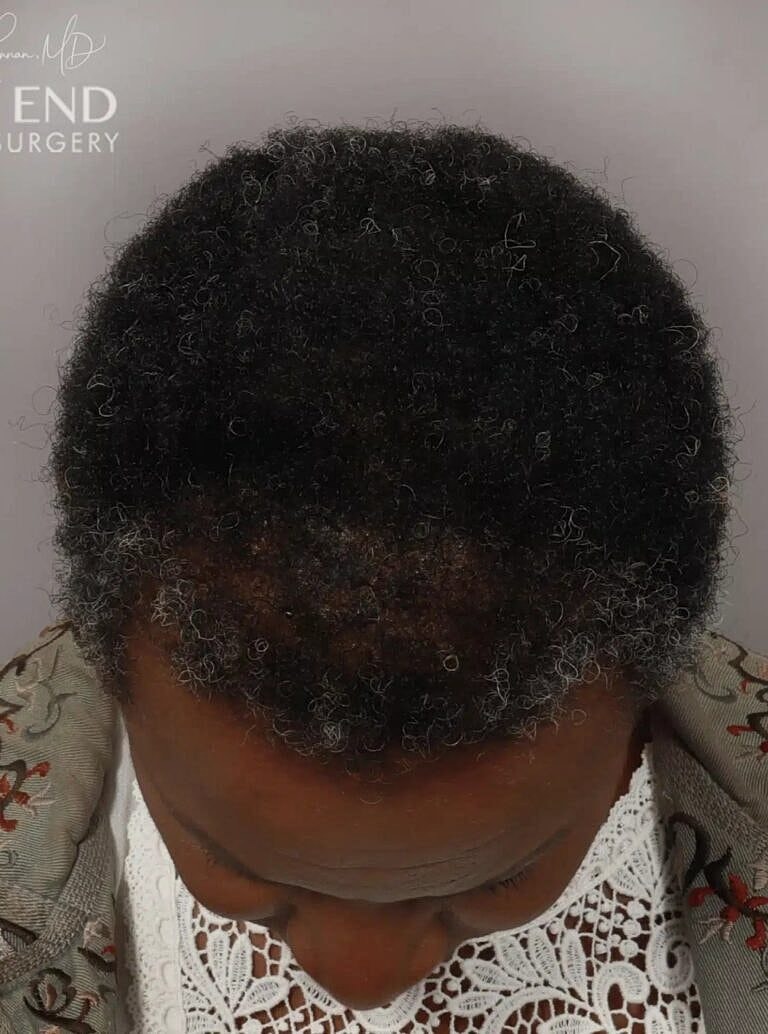 Hair Restoration Before & After