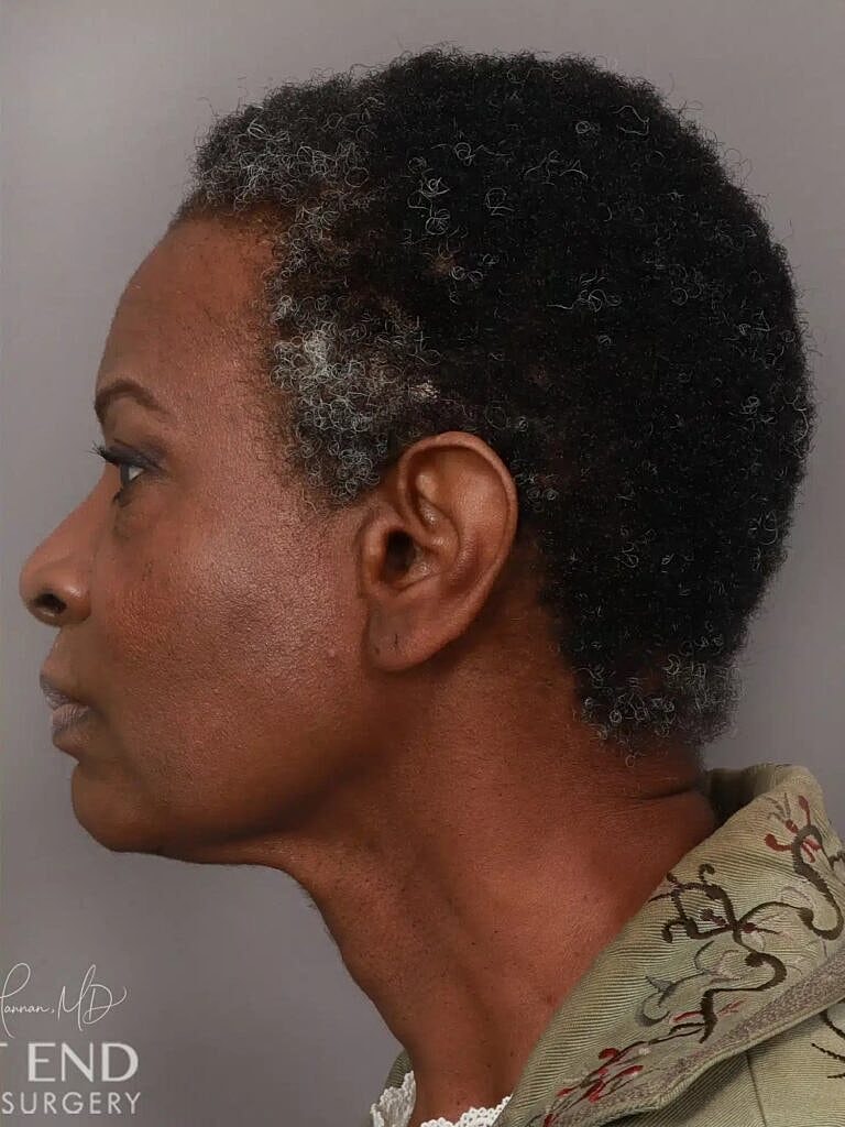 Hair Restoration Before & After