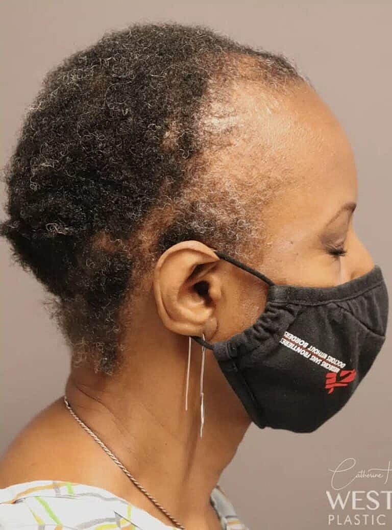 Hair Restoration Before & After