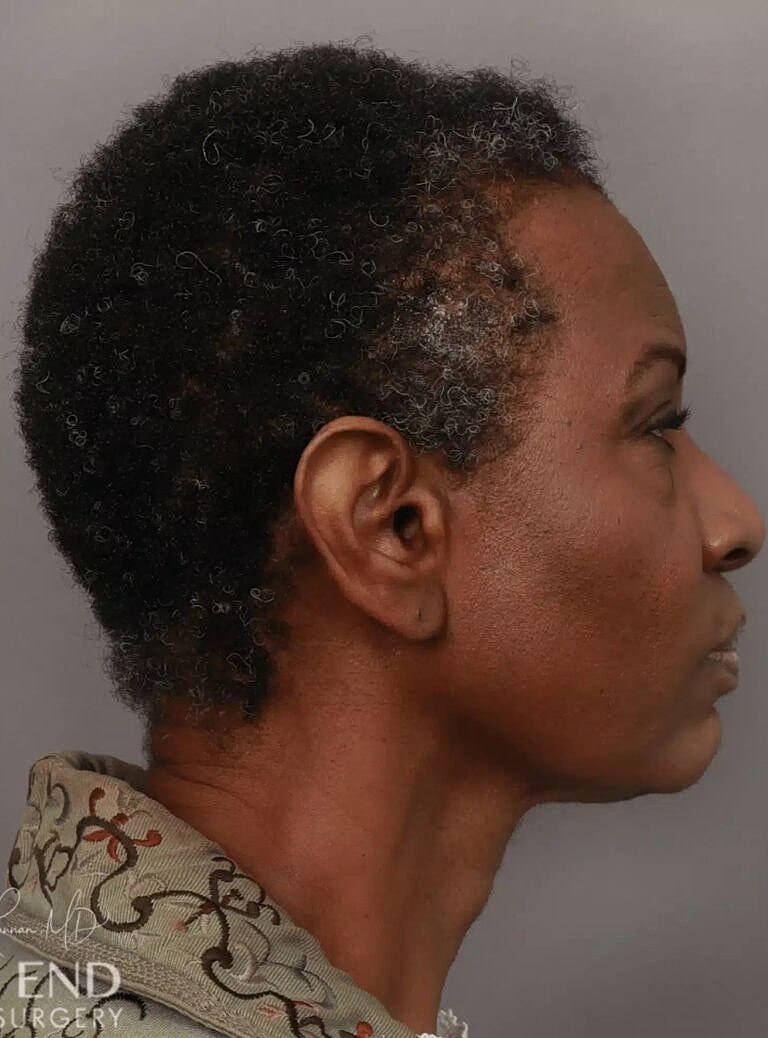 Hair Restoration Before & After