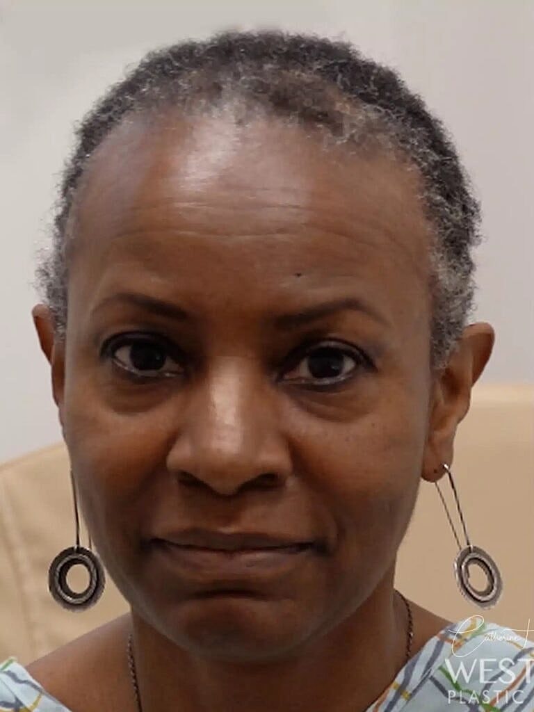 Hair Restoration Before & After