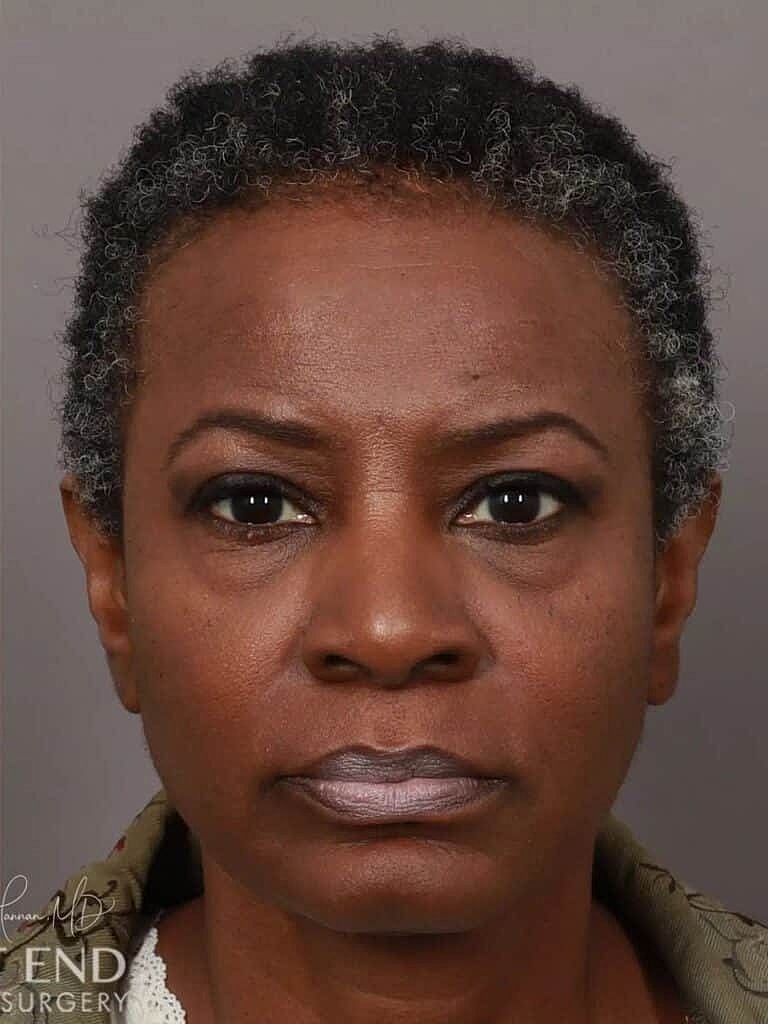 Hair Restoration Before & After