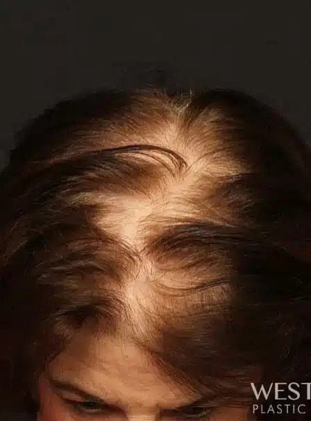 Hair Restoration Before & After