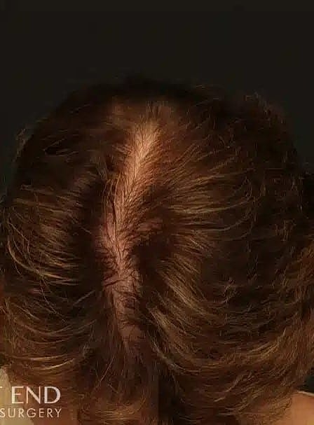 Hair Restoration Before & After