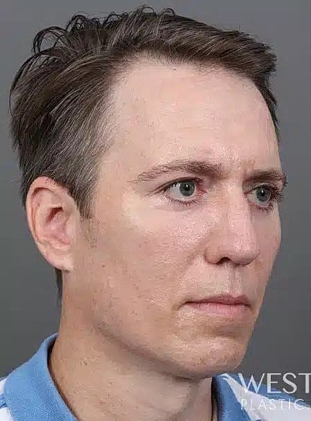 Hair Restoration Before & After