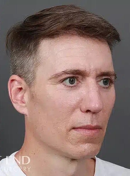 Hair Restoration Before & After