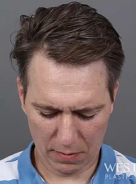 Hair Restoration Before & After