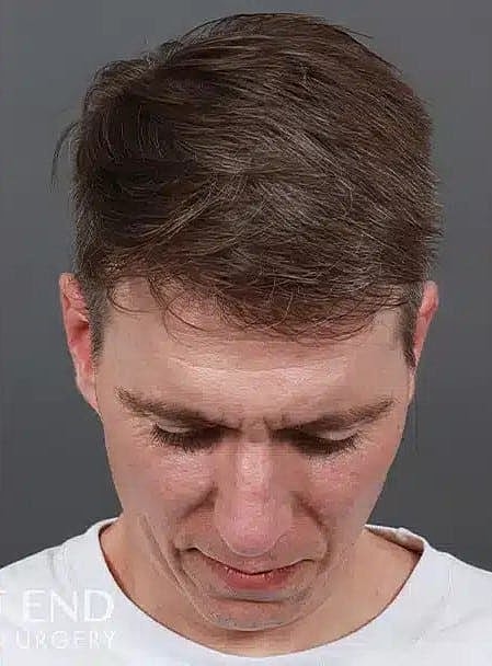 Hair Restoration Before & After