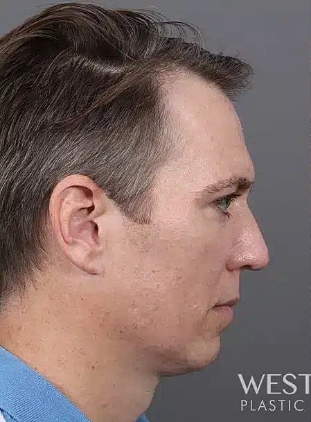 Hair Restoration Before & After