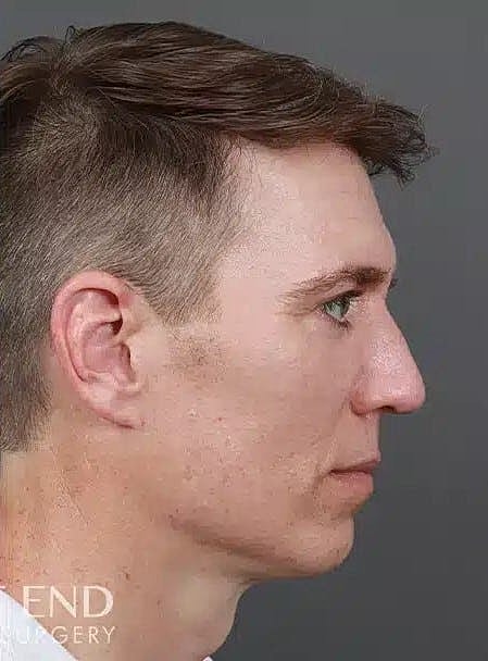 Hair Restoration Before & After