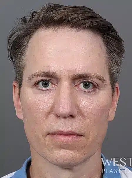 Hair Restoration Before & After