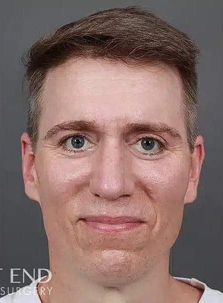 Hair Restoration Before & After