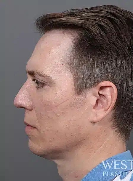 Hair Restoration Before & After