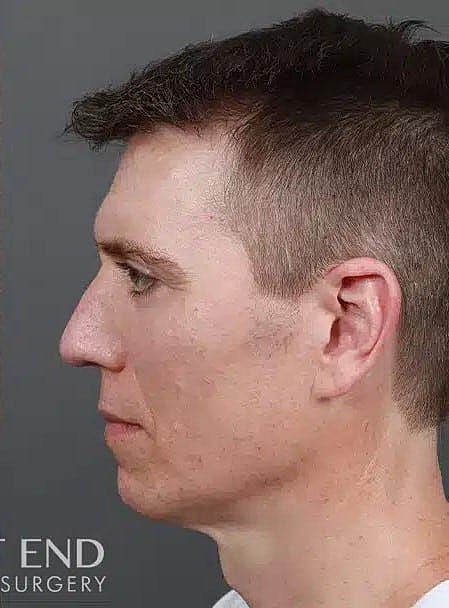 Hair Restoration Before & After