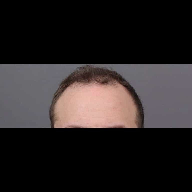 Hair Restoration Before & After