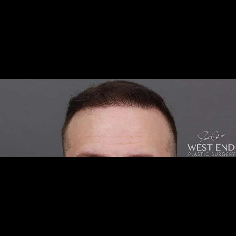 Hair Restoration Before & After