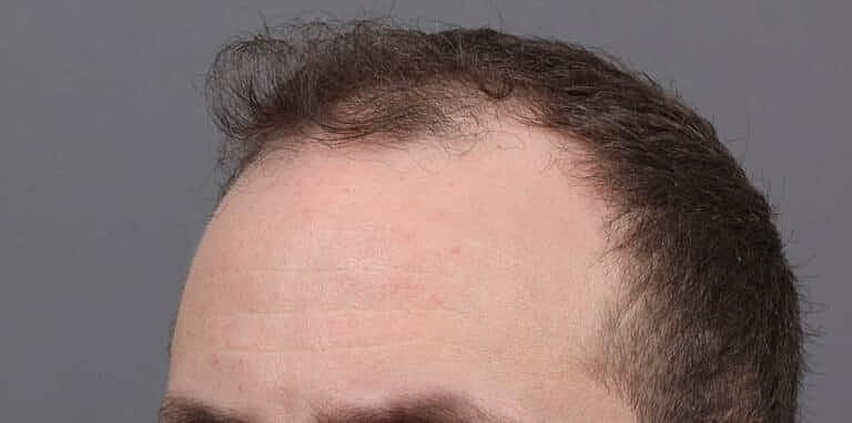 Hair Restoration Before & After