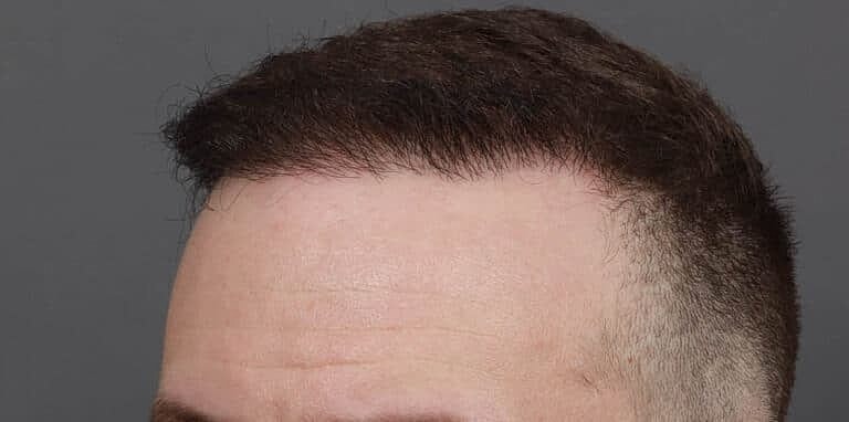 Hair Restoration Before & After