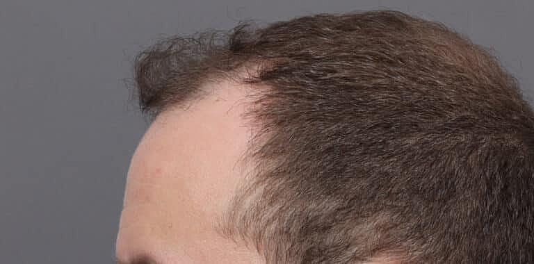 Hair Restoration Before & After