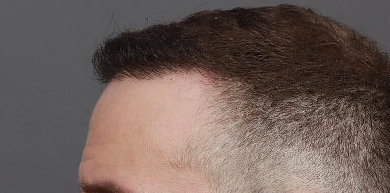 Hair Restoration Before & After