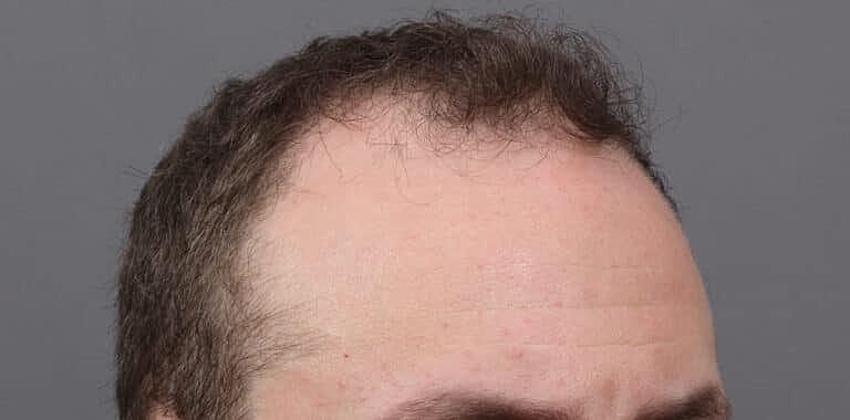 Hair Restoration Before & After