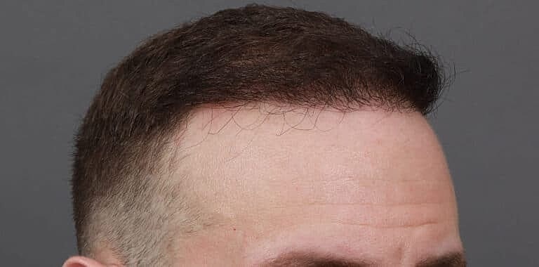 Hair Restoration Before & After