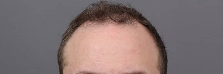 Hair Restoration Before & After