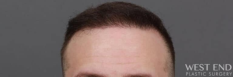 Hair Restoration Before & After