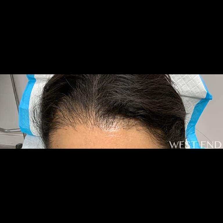 Hair Restoration Before & After