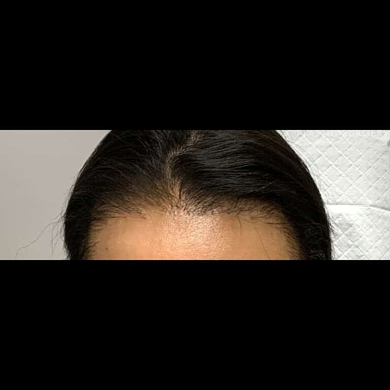 Hair Restoration Before & After