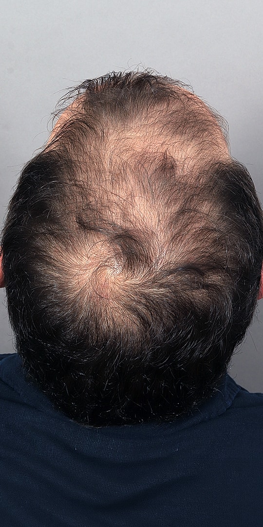 Hair Restoration Before & After