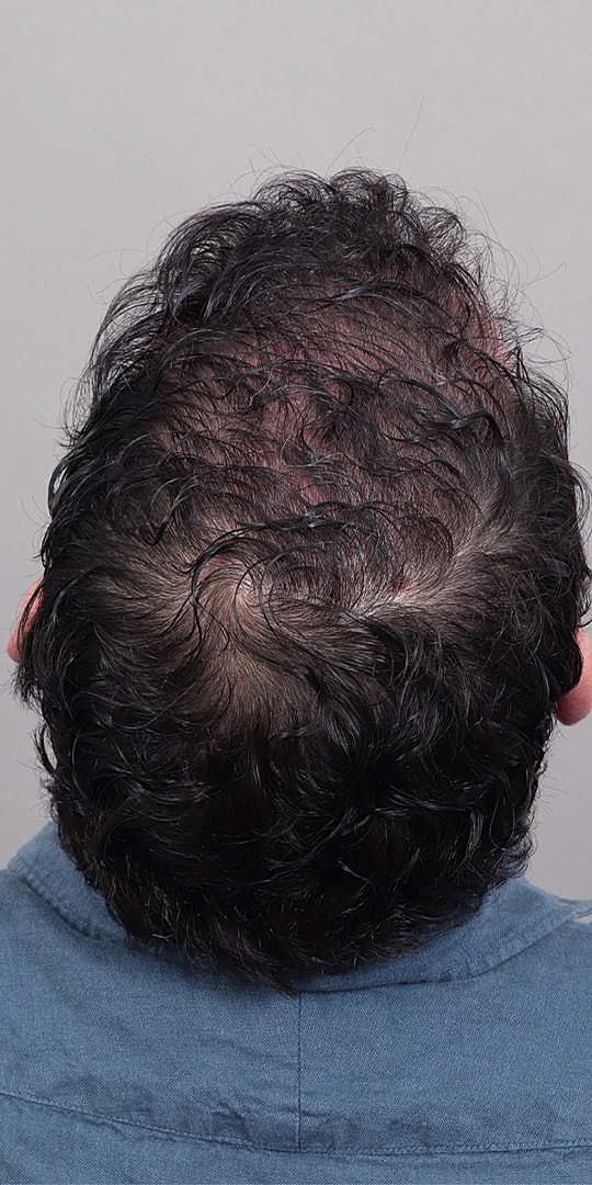 Hair Restoration Before & After