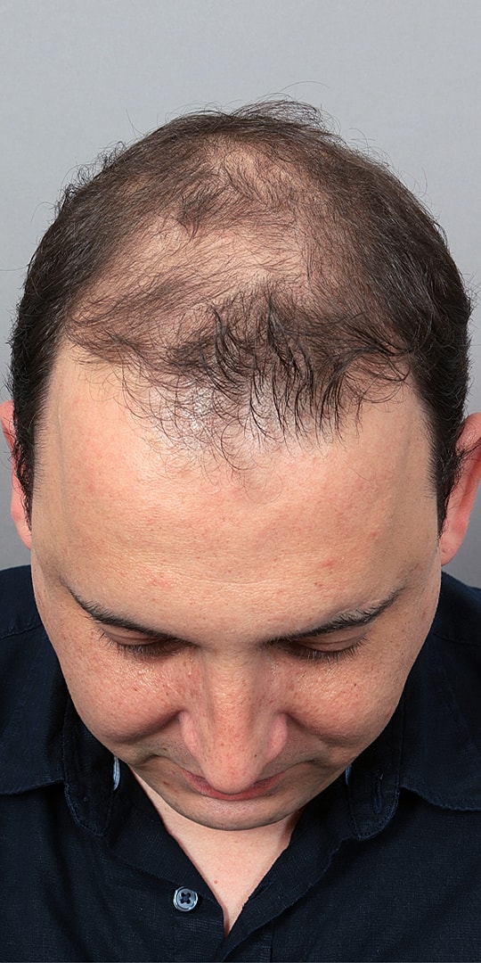 Hair Restoration Before & After