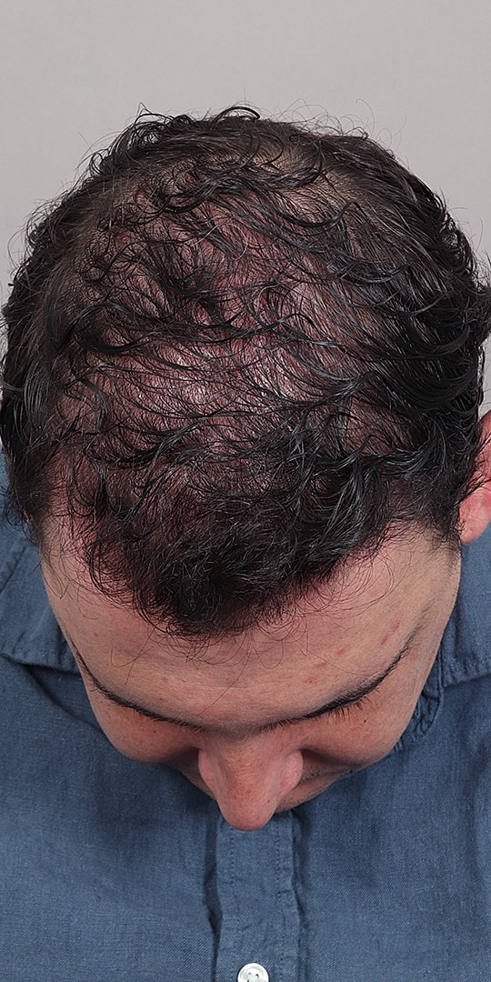 Hair Restoration Before & After