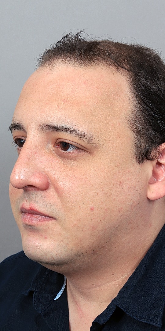 Hair Restoration Before & After