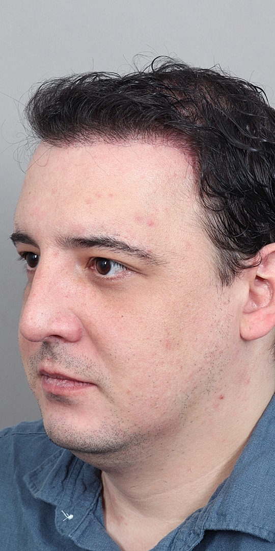 Hair Restoration Before & After