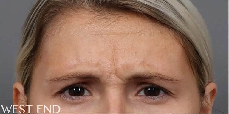 Xeomin Before & After