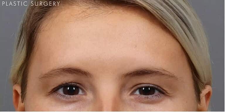 Xeomin Before & After