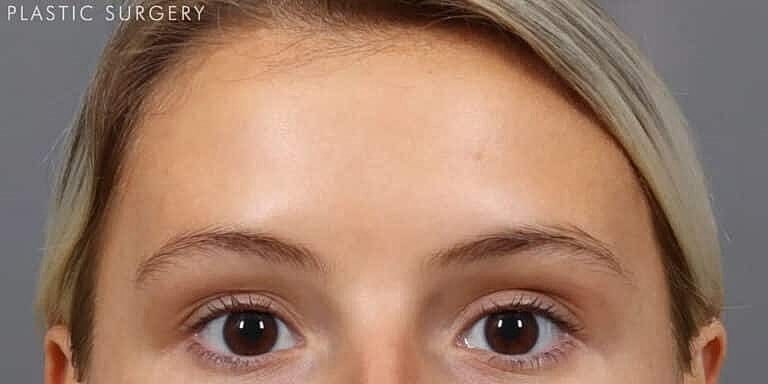 Xeomin Before & After