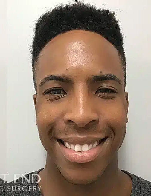 Xeomin Before & After