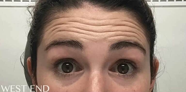 Xeomin Before & After